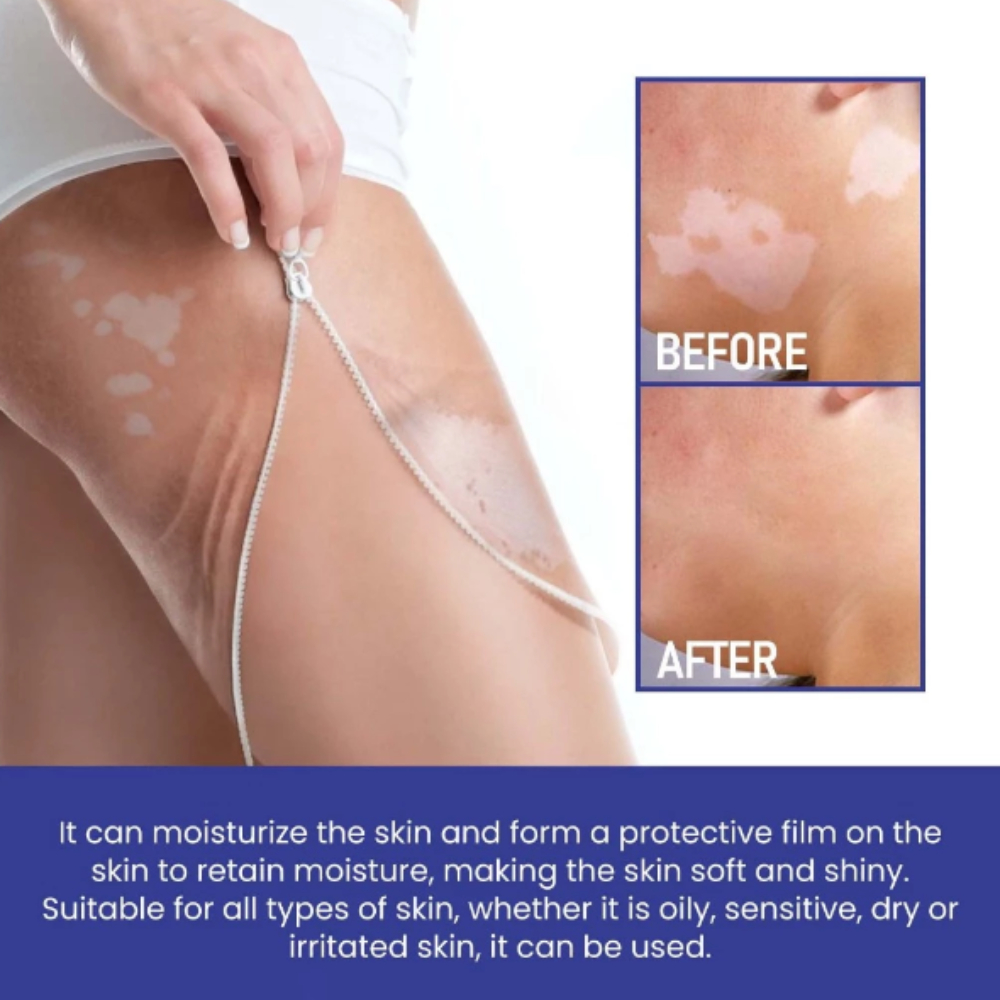 Tinh chất bôi lang ben, bạch biến OUHOE - Serum OUHOE hỗ trợ làm đều màu da, loại bỏ hắc lào, đốm trắng,...