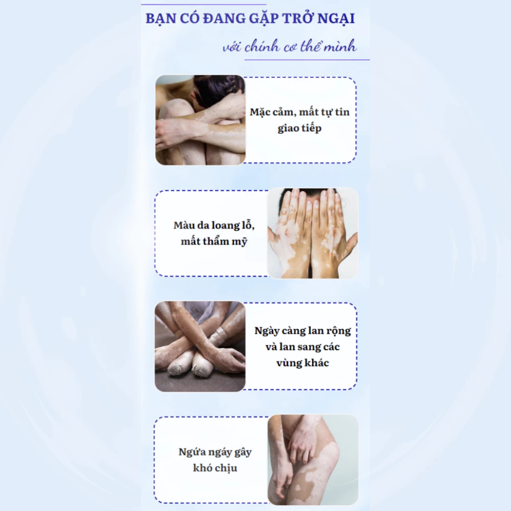 Tinh chất bôi lang ben, bạch biến OUHOE - Serum OUHOE hỗ trợ làm đều màu da, loại bỏ hắc lào, đốm trắng,...