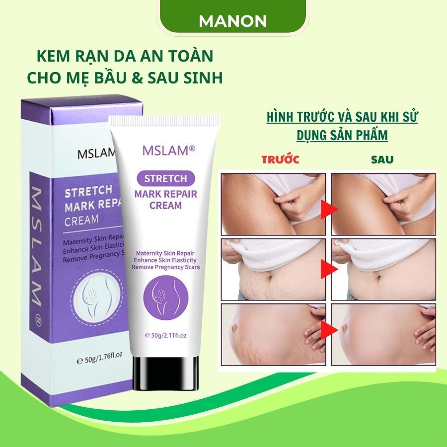 Kem Rạn Mslam Kem Dạn Da Sau Sinh Hỗ Trợ Giảm Rạn Da Săn Chắc Da Sau Sinh Cho Da Mịn Màng