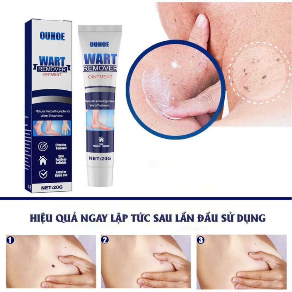 Kem tẩy mụn thịt OUHOE - Không còn nổi lo mụn thịt mụn nốt ruồi với kem tẩy mụn OUHOE, đánh bay các loại mụn - QUINN BEA