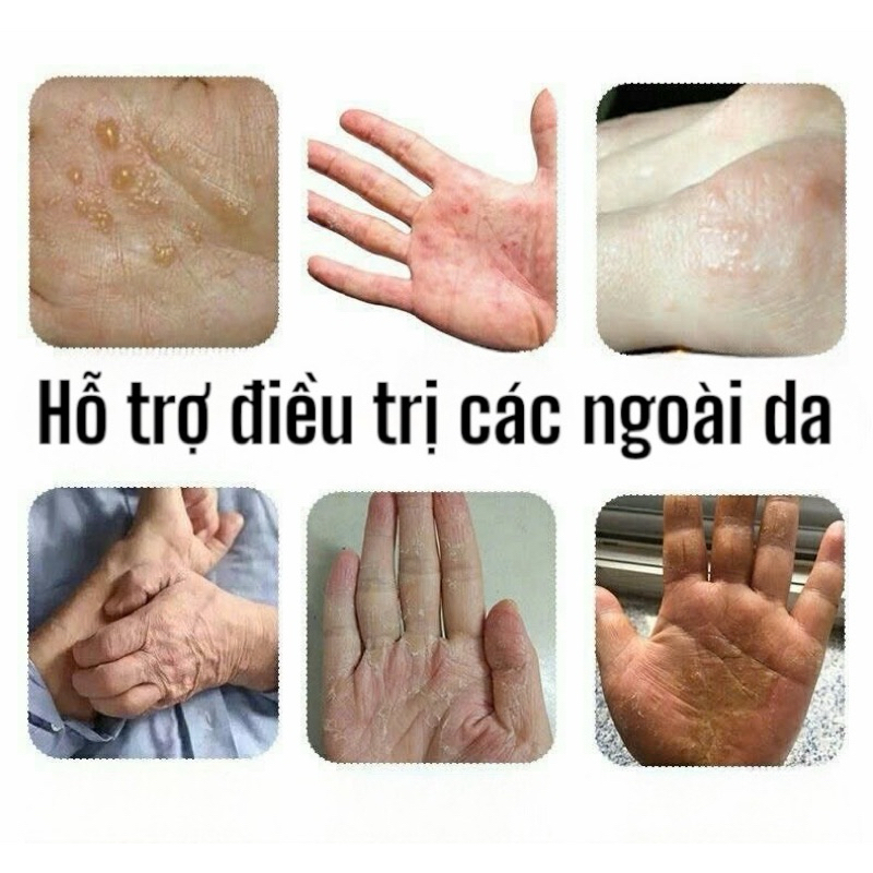 Kem KOBAYASHI Bôi Viêm Da Cơ Địa, Nấm Ngứa, Hắc Lào, Tổ Đỉa, Ghẻ Nước - Kem Bôi Á Sừng Viêm Da KOBAYASHI Nhật Bản