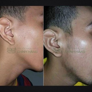 Dung dịch mọc Râu Tóc Kirkland Minoxidil 5% Foam Dạng Bọt USA Mẫu Mới