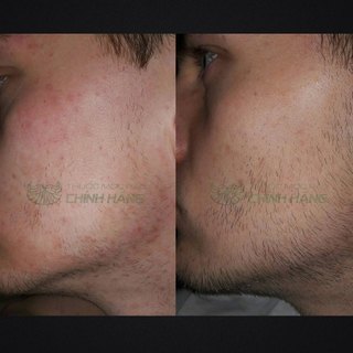 Dung dịch mọc Râu Tóc Kirkland Minoxidil 5% Foam Dạng Bọt USA Mẫu Mới