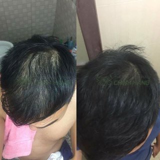 Dung dịch bôi Minoxidil 5% Date Mới Hỗ Trợ Mọc Râu Tóc