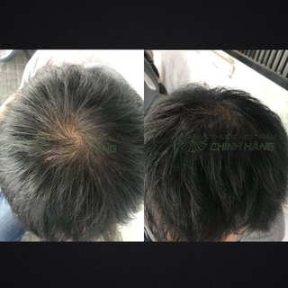 Dung dịch bôi Minoxidil 5% Date Mới Hỗ Trợ Mọc Râu Tóc