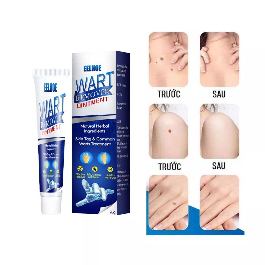 Kem Wart Remover Ointment loại bỏ mụn cóc mụn thịt nốt ruồi trên da từ thảo dược thiên nhiên cao cấp không gây sẹo
