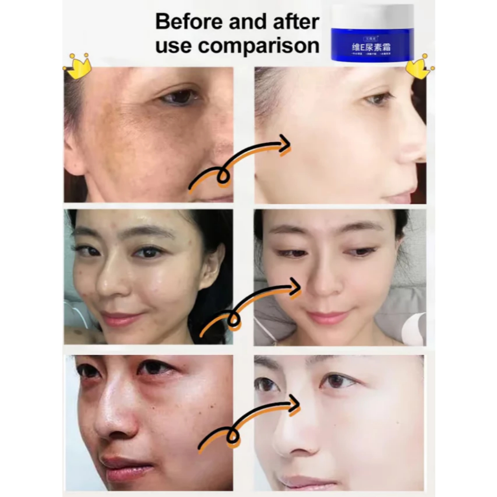 Kem Dưỡng Xóa Hắc Tố Thâm Sạm UREA - Kem Dưỡng Làm Mờ Thâm Sạm, Nám, Tàn Nhang UREA, Giúp Làn Da Sáng Bóng Và Đều M