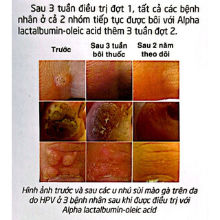 Gel bôi HPV, Sủi mào gà, Mụn cóc, Mụn Cơm