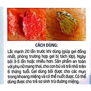 Gel bôi HPV, Sủi mào gà, Mụn cóc, Mụn Cơm