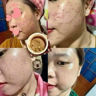 CAO MỤN SÂM ĐỎ 36 VỊ Hộp lớn 15g(chính hãng 100%)