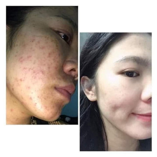 CAO MỤN SÂM ĐỎ 36 VỊ Hộp lớn 15g(chính hãng 100%)