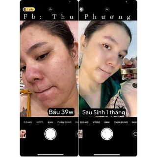 CAO MỤN SÂM ĐỎ 36 VỊ Hộp lớn 15g(chính hãng 100%)