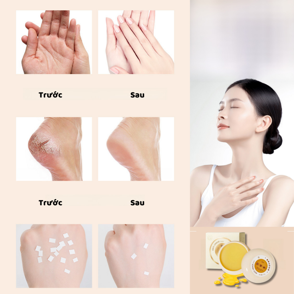 Kem bôi nứt nẻ HEYXI - Kem bôi KEYXI cải thiện da bị khô nứt và giúp dưỡng ẩm cho da, mang lại làn da tươi mới - QUINN