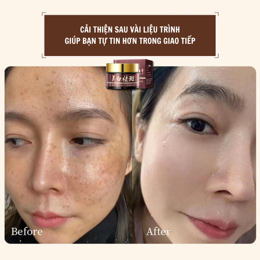 Kem dưỡng trắng sáng da, xóa tàn nhang nám sạm trên da, giúp phục hồi làn da, loại bỏ hắc tố trên da - QUINN BEAUTY