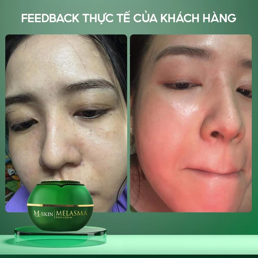Combo kem face nám siêu trắng BLUR MELASMA 20g và serum Nám cốt sâm MQ SKIN chính hãng | BigBuy360 - bigbuy360.vn