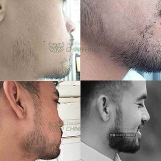 Dung dịch bôi Minoxidil 5% Date Mới Hỗ Trợ Mọc Râu Tóc
