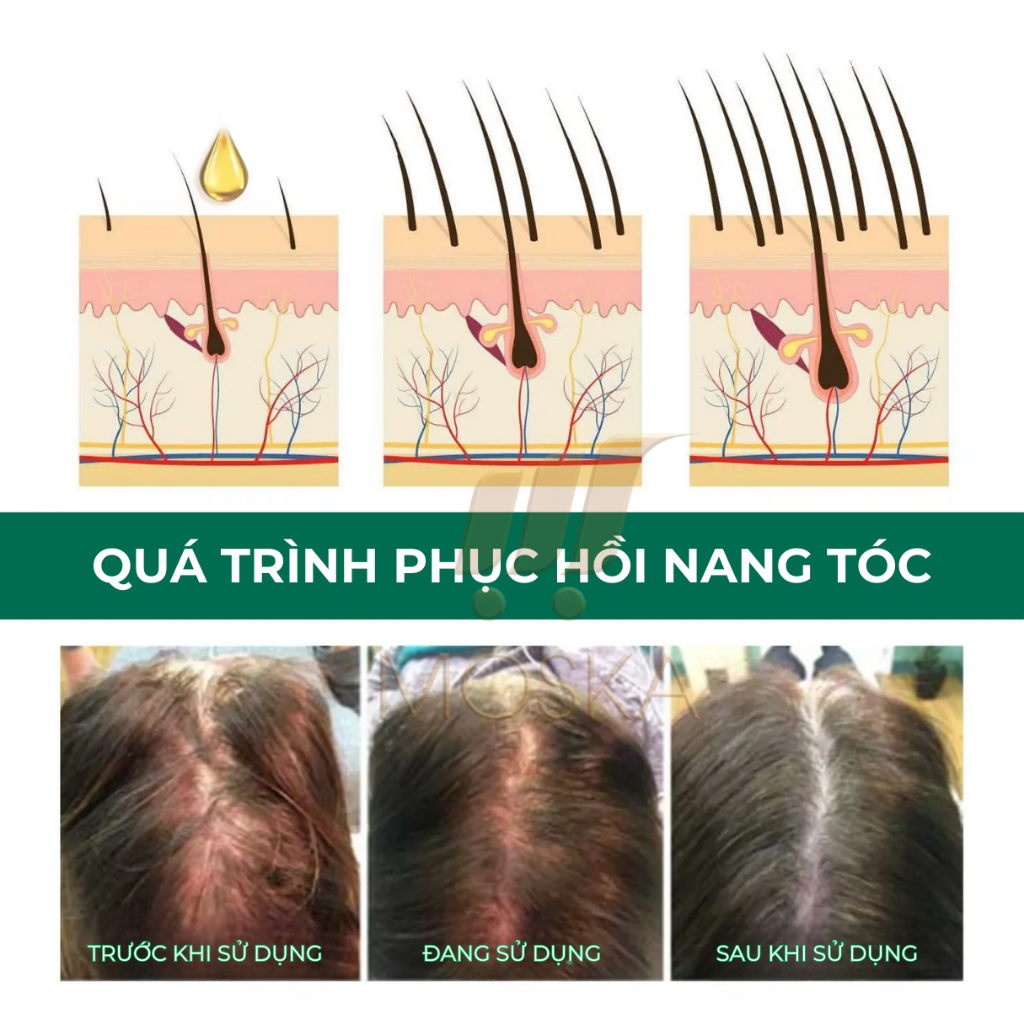 Kem viêm nấm ngứa da đầu, viêm nang tiết bã, viêm nang tóc, viêm nang lông IWAI, Sạch Nấm, Mụn Viêm Ngứa sau 7 ngày