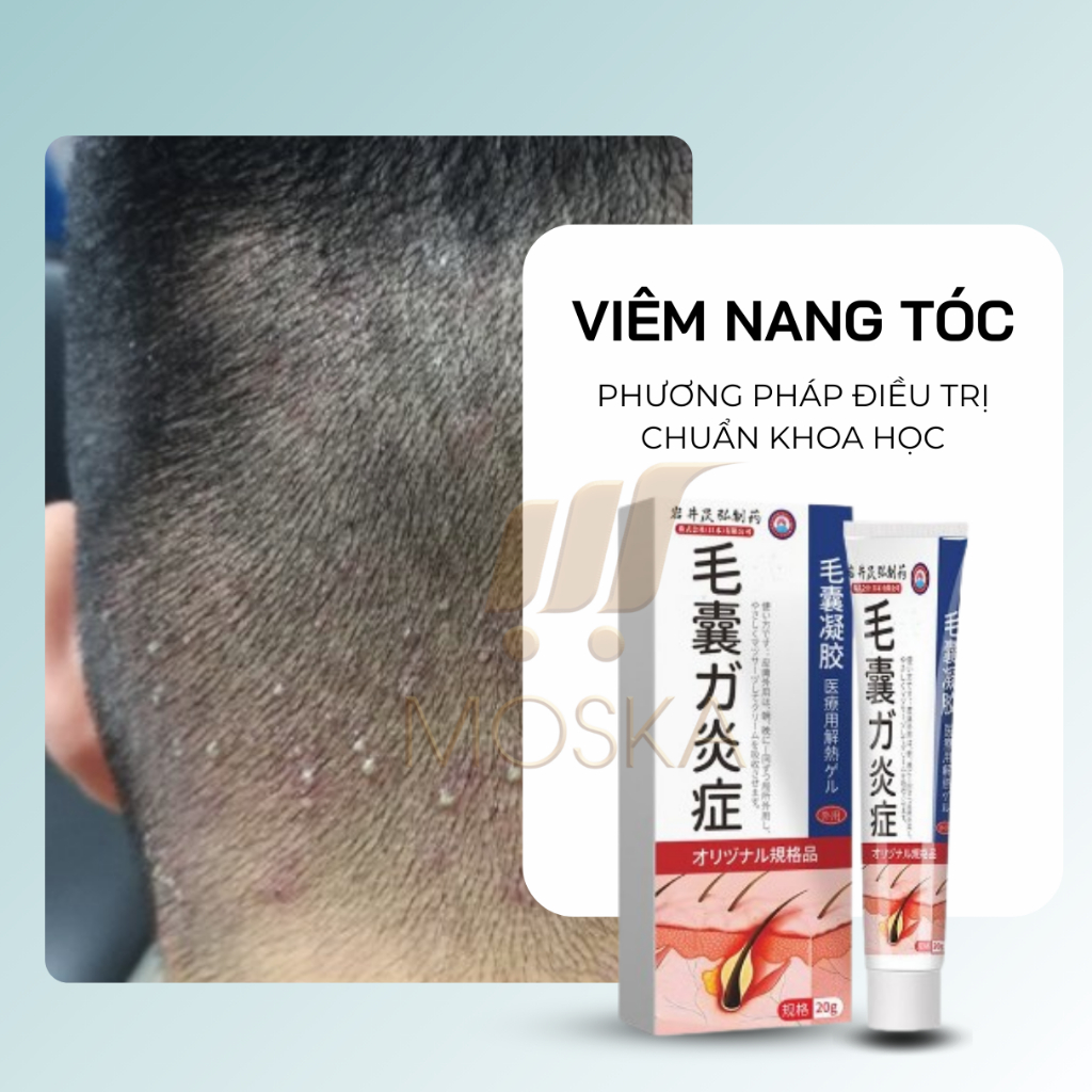 Kem viêm nấm ngứa da đầu, viêm nang tiết bã, viêm nang tóc, viêm nang lông IWAI, Sạch Nấm, Mụn Viêm Ngứa sau 7 ngày