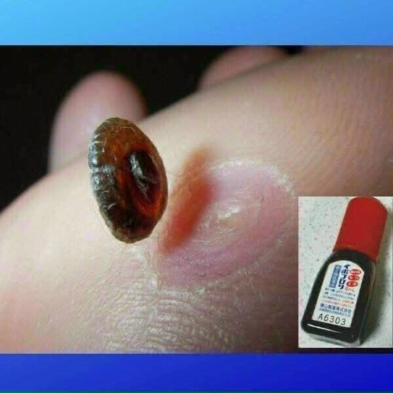 Tinh Chất Chấm Rụng Mụn Cóc Chai Cứng Trên Cơ Thể Ibokorori Nhật Bản 10ml