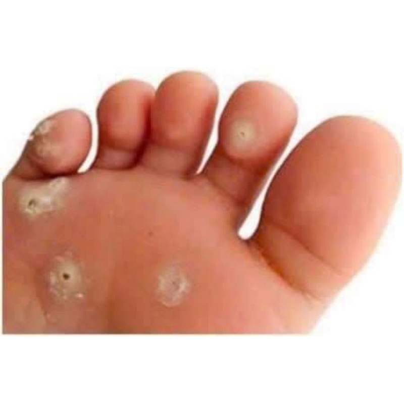 Tinh Chất Chấm Rụng Mụn Cóc Chai Cứng Trên Cơ Thể Ibokorori Nhật Bản 10ml