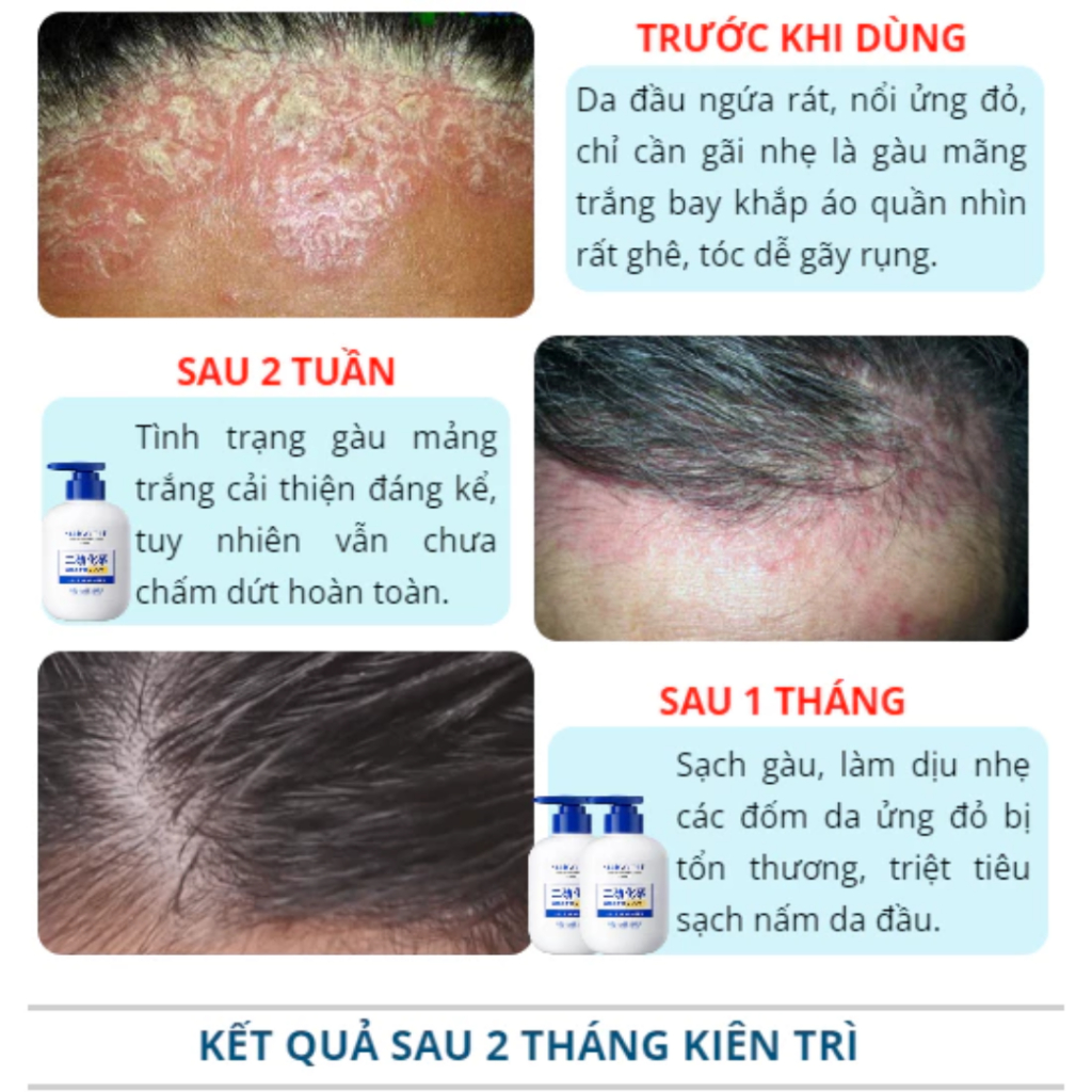 Dầu gội cải thiện gàu MAIGOOLE - Dầu gội dược liệu giúp cải thiện các tình trạng nấm ngứa gàu trên da đầu - QUINN BEAUTY
