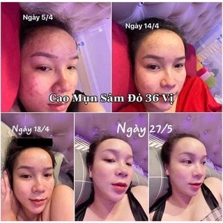 Cao mụn sâm đỏ 36 vị 15gr