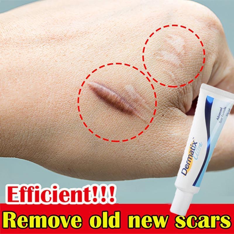 Kem xóa sẹo gel để làm nhẹ vết bỏng sẹo hiệu quả loại bỏ sẹo, sẹo lồi, bỏng do tai nạn, sẹo lồi phẫu thuật, sẹo nổi