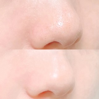 Miếng dán đẩy mụn Good Bye Blackhead Giracle 5g