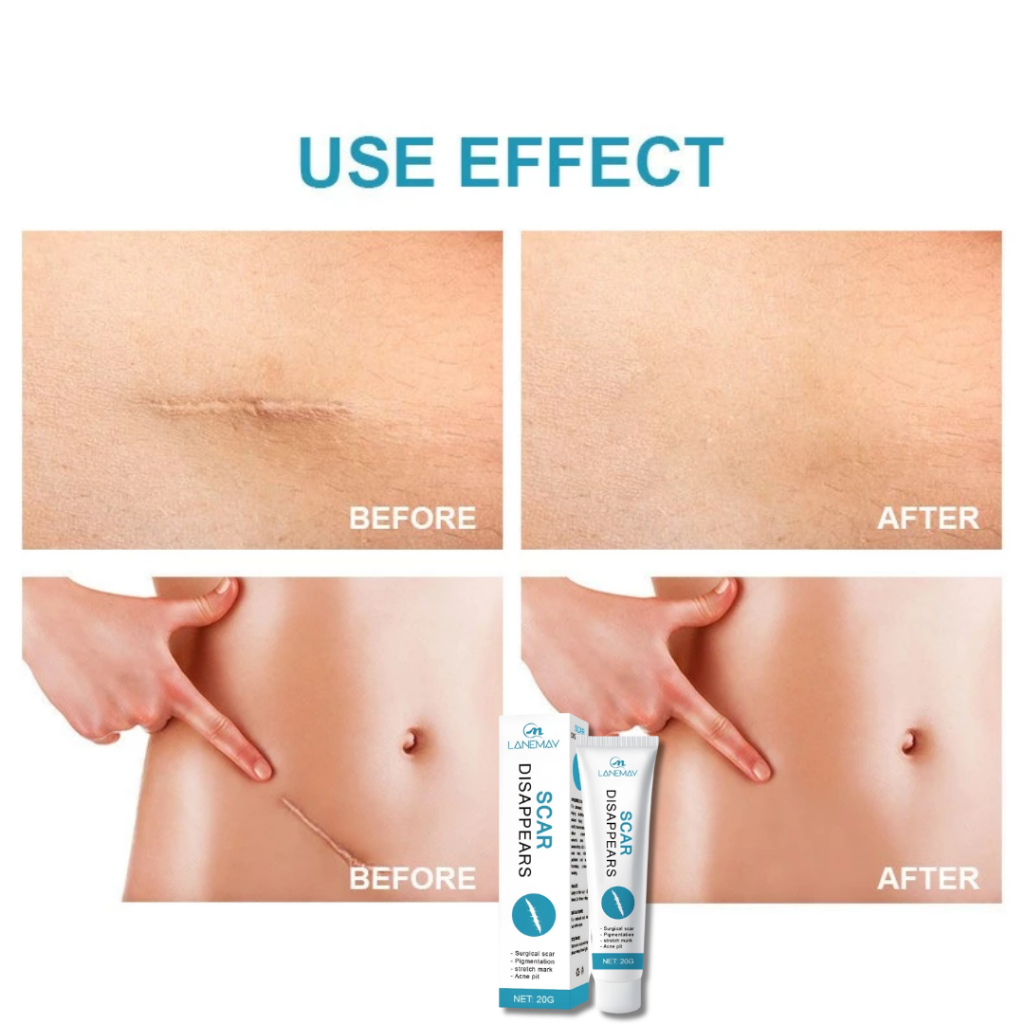 Kem mờ sẹo mờ thâm SCAR DISAPPEARS - Kem bôi giúp cải thiện mọi sẹo trên da, sẹo phẩu thuật, sẹo sau sinh - QUINN