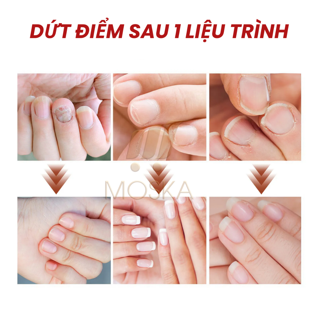 Tinh Chất Nấm Móng Tay Chân Kannedo Nhật Bản 30ML Giảm Nấm Móng, Hỗ Trợ Giảm Hư Móng, Dưỡng Móng Dày Và Khỏe| Moska shop