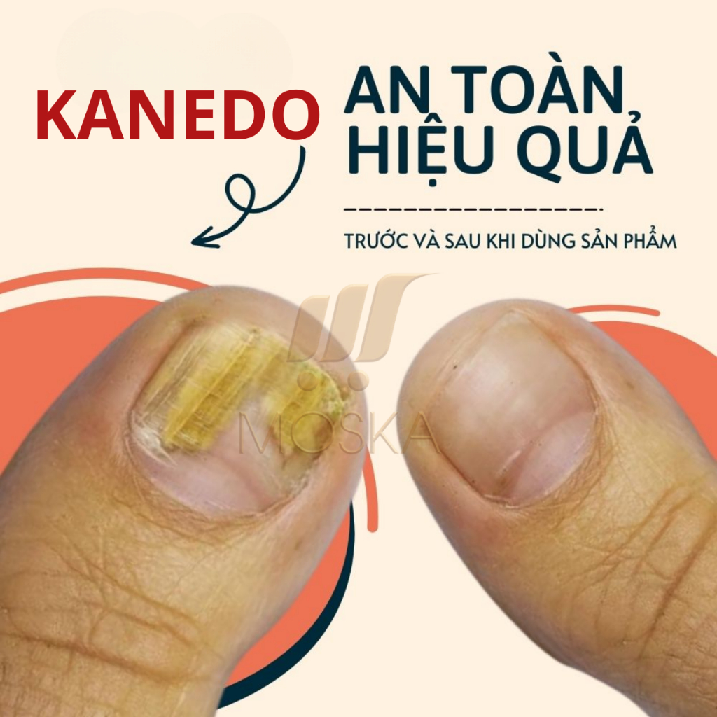 Tinh Chất Nấm Móng Tay Chân Kannedo Nhật Bản 30ML Giảm Nấm Móng, Hỗ Trợ Giảm Hư Móng, Dưỡng Móng Dày Và Khỏe| Moska shop