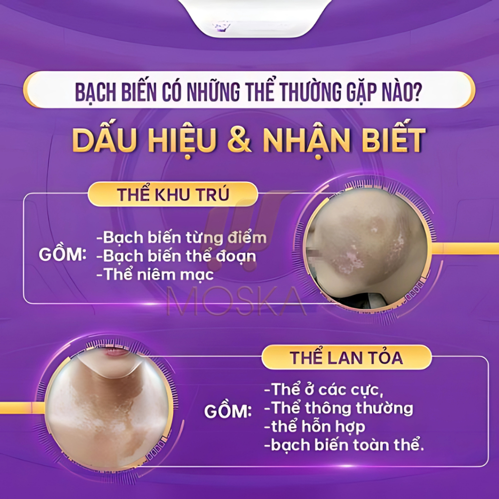 Xịt Bạch Biến Nhật Bản Senko - Tinh Chất Thảo Dược Nhật Bản Loại Bỏ Đốm Trắng, Làm Đều Màu Da, Lang Ben