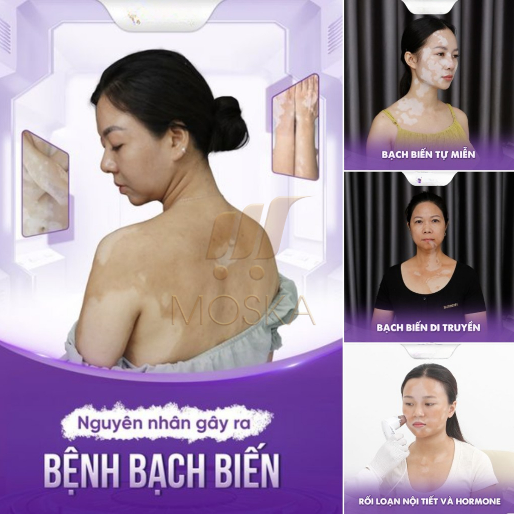 Xịt Bạch Biến Nhật Bản Senko - Tinh Chất Thảo Dược Nhật Bản Loại Bỏ Đốm Trắng, Làm Đều Màu Da, Lang Ben