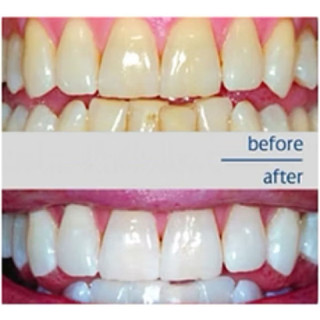 Set Kem Đánh Răng Và Đèn Chiếu Teeth Flash White NHẬT BẢN
