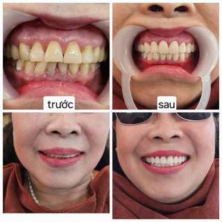Set Kem Đánh Răng Và Đèn Chiếu Teeth Flash White NHẬT BẢN