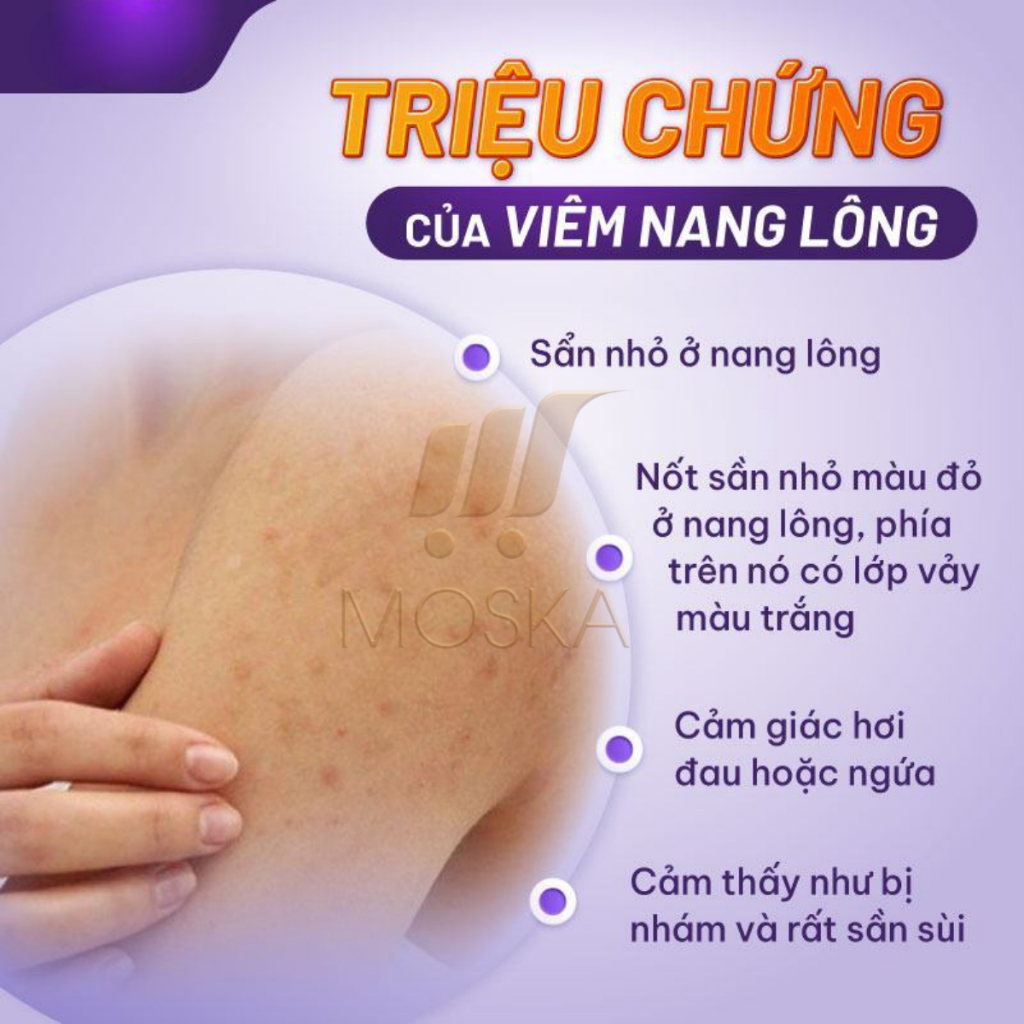 Kem Da Liễu Viêm Nang Lông UERA 200ml, Sạch Lỗ Chân Lông, Loại Bỏ Sừng Nang Lông, Ngăn Ngừa Mụn, Dưỡng Trắng, Da Mềm Mịn