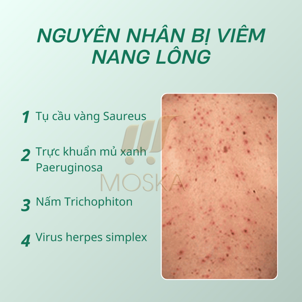 Kem Da Liễu Viêm Nang Lông UERA 200ml, Sạch Lỗ Chân Lông, Loại Bỏ Sừng Nang Lông, Ngăn Ngừa Mụn, Dưỡng Trắng, Da Mềm Mịn