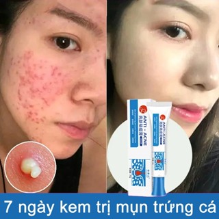  Kem chấm mụn cấp tốc  loại bỏ các loại mụn mụn đầu đen,mụn ở tuổi dậy thì,loại bỏ mụn bọc cho da dầu 25g 