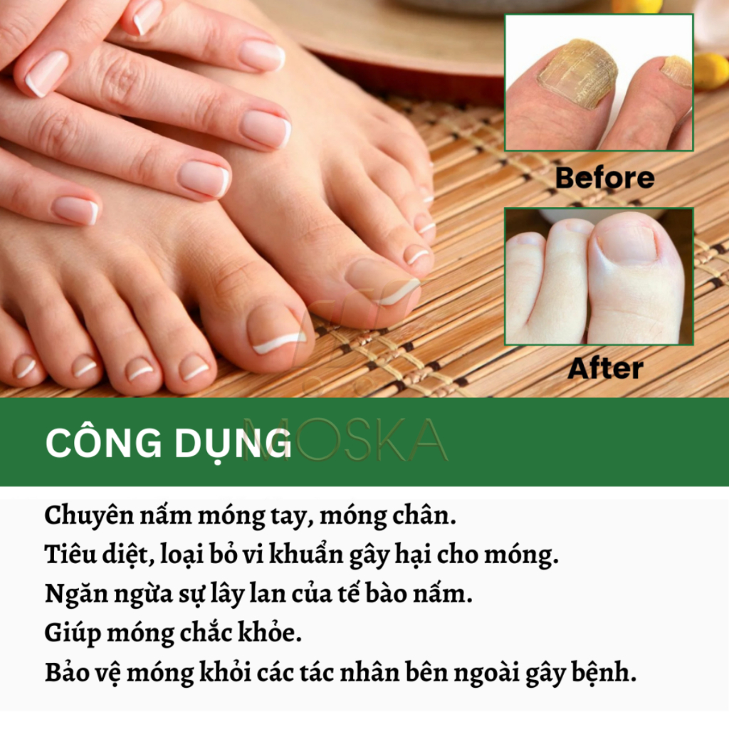 Serum Tri Nấm Móng Tay Chân Hư Khoé EELHOE Mỹ 30ML Phục Hồi Móng Thối, Móng Hư, Giòn Nứt Móng,  Dưỡng Móng Dài | Moska