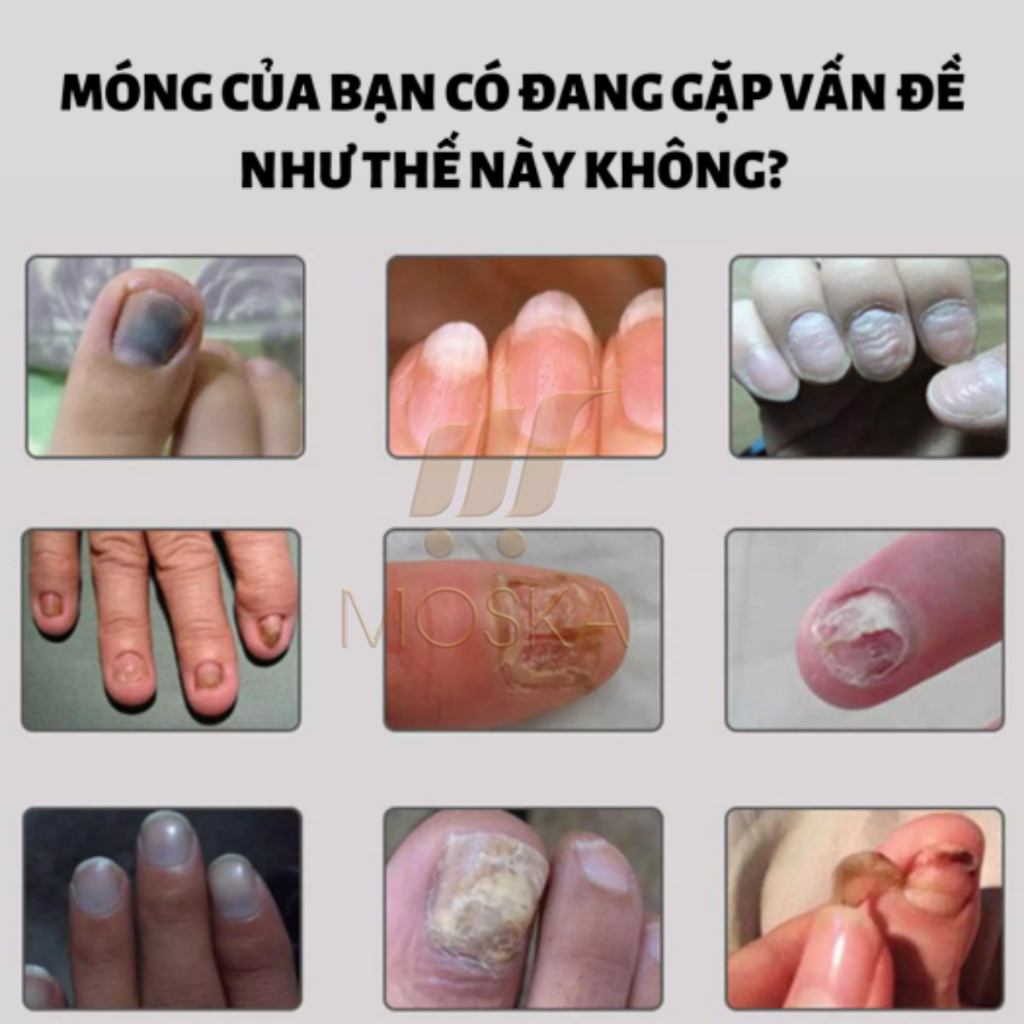 Serum Tri Nấm Móng Tay Chân Hư Khoé EELHOE Mỹ 30ML Phục Hồi Móng Thối, Móng Hư, Giòn Nứt Móng,  Dưỡng Móng Dài | Moska