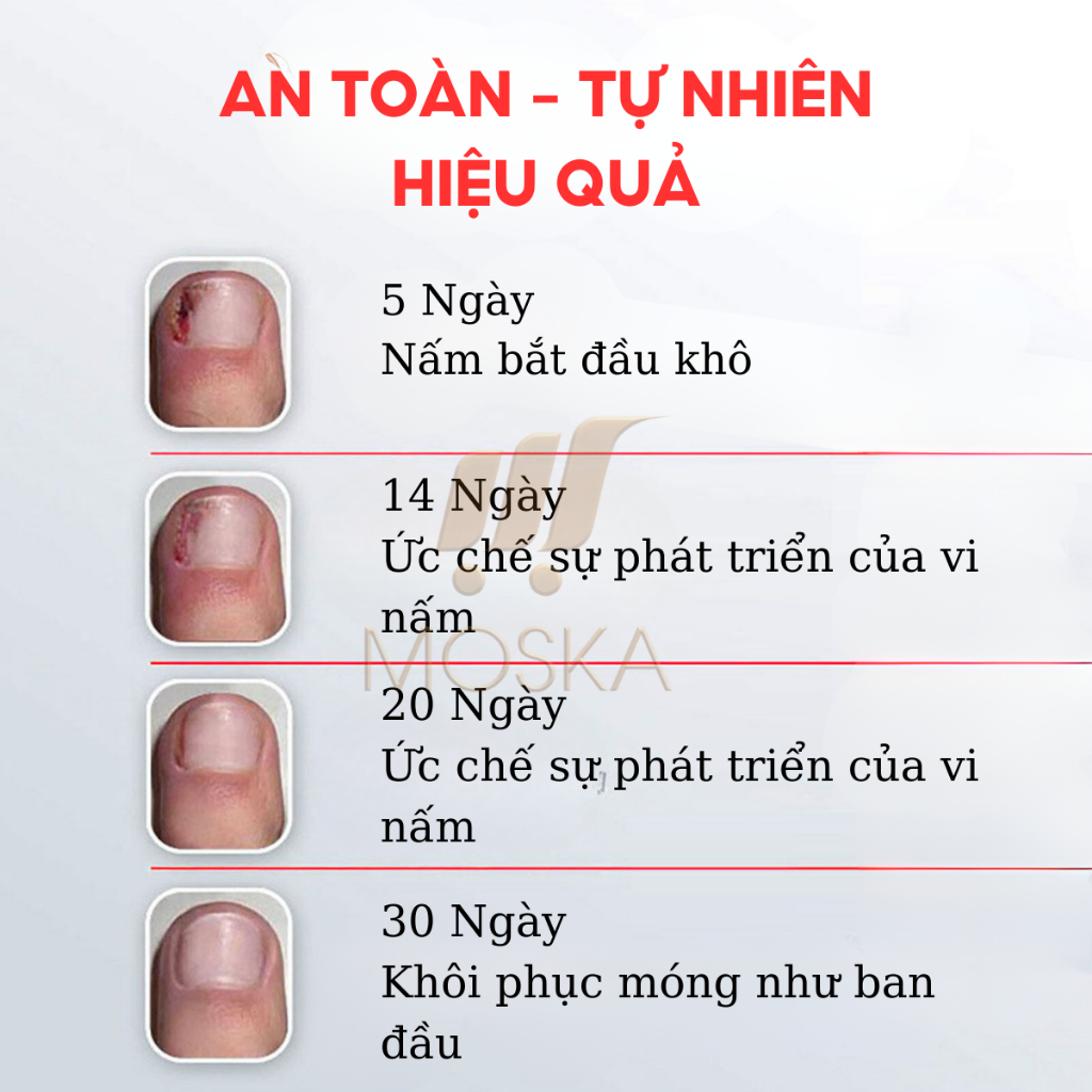 Serum Tri Nấm Móng Tay Chân Hư Khoé EELHOE Mỹ 30ML Phục Hồi Móng Thối, Móng Hư, Giòn Nứt Móng,  Dưỡng Móng Dài | Moska