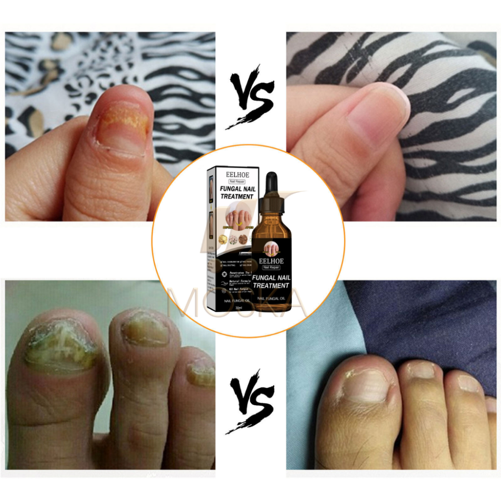 Serum Tri Nấm Móng Tay Chân Hư Khoé EELHOE Mỹ 30ML Phục Hồi Móng Thối, Móng Hư, Giòn Nứt Móng,  Dưỡng Móng Dài | Moska