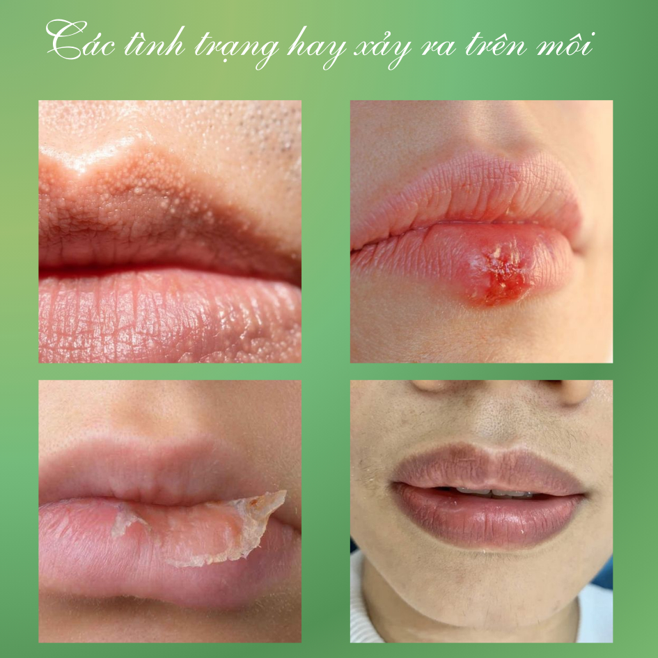 Kem Dưỡng Môi SUMIFUN Loại Bỏ Hạt Fordyce, Giảm Mụn Bã Nhờn, Dưỡng Ẩm, Phục Hồi Da & Giúp Môi Hồng Hào Tự Nhiên | BKINNO