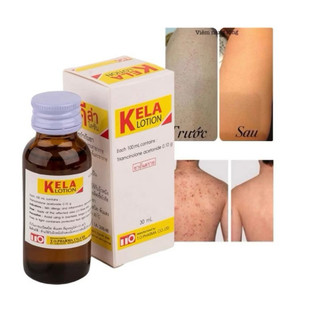 Viêm nang lông Kela, viêm lỗ chân lông kela lotion thảo dược Thái Lan 30ml, 60ml CHE TÊN