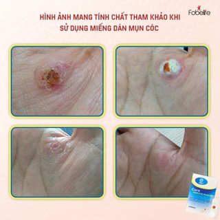 Miếng Dán Mụn Cóc Fobe Không Gây Đau Rát, An Toàn Tại Nhà Corn Removal Plaster ( Hộp 6 miếng )