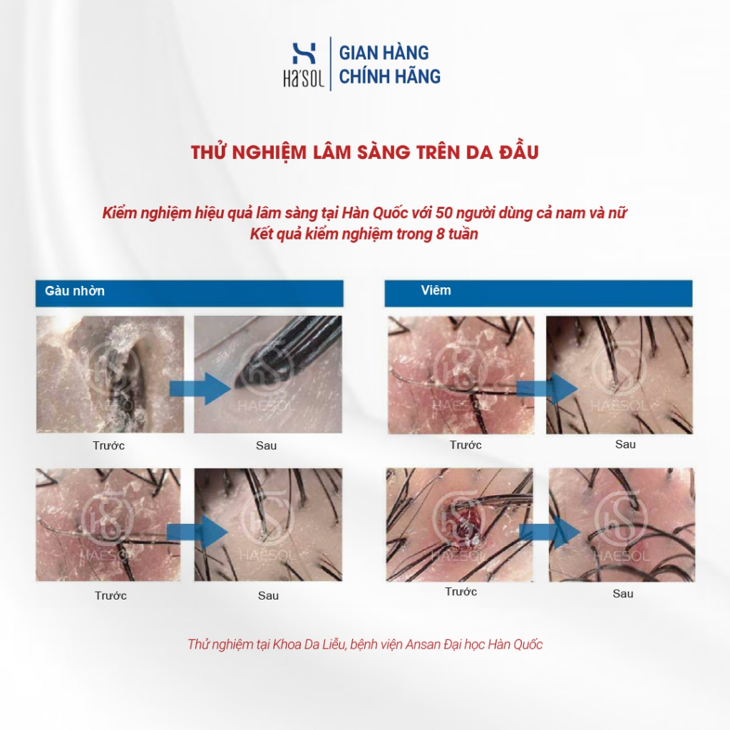 Dầu Gội HASOL Hỗ Trợ Giảm Gàu Nấm Ngứa, Phù Hợp Cho Da Đầu Nhiều Dầu, Tóc Mỏng Và Yếu HA'SOL Clean Scalp Shampoo 500g | BigBuy360 - bigbuy360.vn