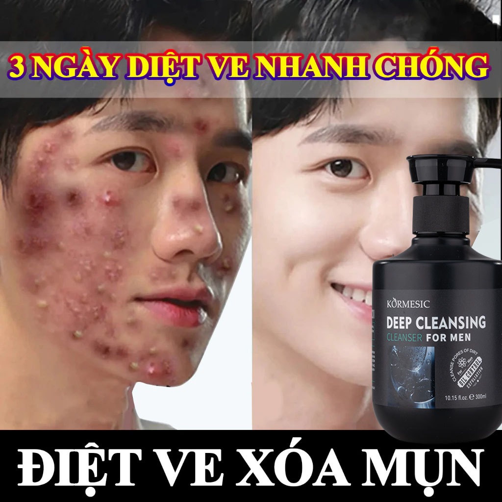 Sữa rửa mặt nam giới Sữa rửa mặt cho da mụn 300ml cho sáng da sạch sâu kiềm dầu giảm mụn thâm hiệu quả