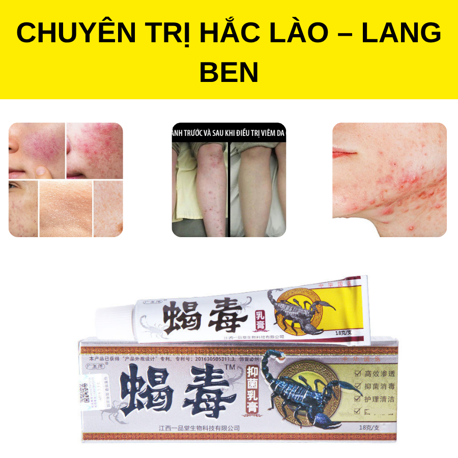 [bọ cạp] Kem bọ cạp bôi nấm ngứa, hắc lào, á sừng,vẩy nến ,Da Đầu kem hỗ trợ bôi da hết ngứa sau 5 phút