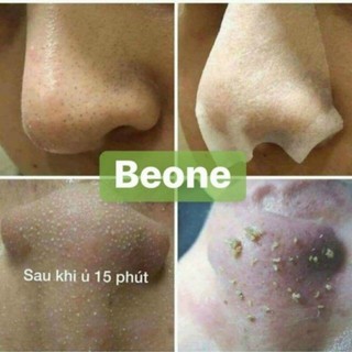 Mụn Đầu Đen Mụn Cám YOUNGERC 30ml | Đánh Bay Mụn Đầu Đen, Sạch Mụn Cám Nhanh Và Hiệu Quả