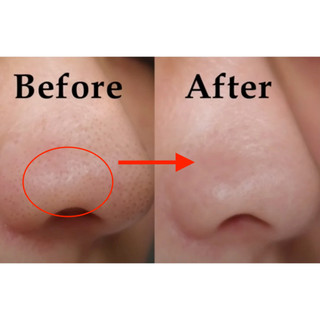 Mụn Đầu Đen Mụn Cám YOUNGERC 30ml | Đánh Bay Mụn Đầu Đen, Sạch Mụn Cám Nhanh Và Hiệu Quả